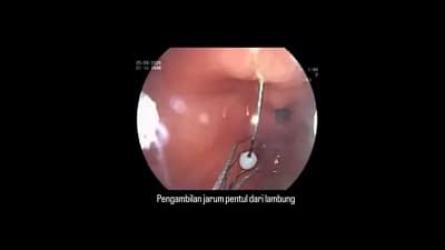 Viral Detik-detik Dokter Keluarkan Jarum Pentul dari Lambung, Tertelan ketika Pakai Hijab