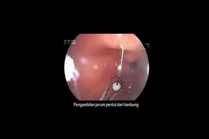 Viral Detik-detik Dokter Keluarkan Jarum Pentul dari Lambung, Tertelan ketika Pakai Hijab